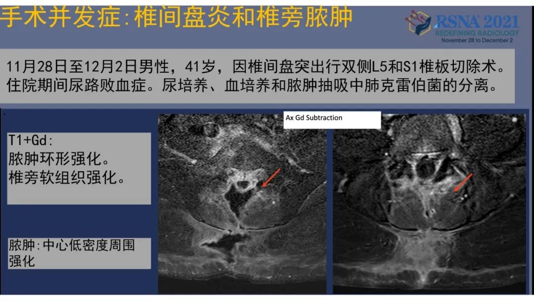 【PPT】术后脊柱-为了外科医生和患者安全着想的金属图像-39