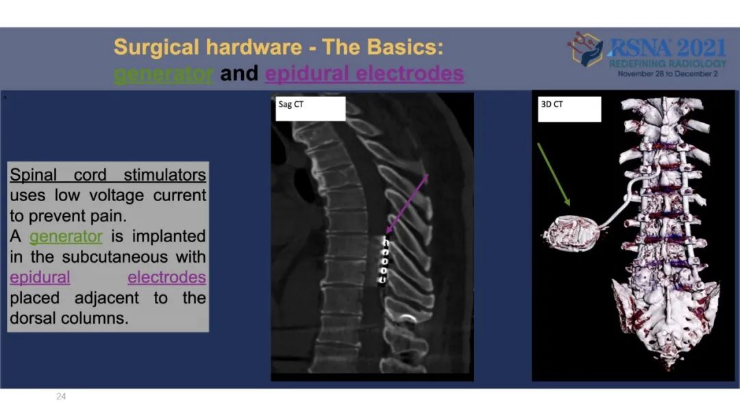【PPT】术后脊柱-为了外科医生和患者安全着想的金属图像-24