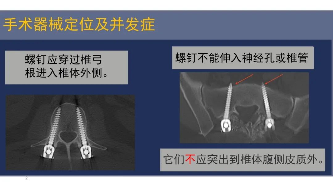 【PPT】术后脊柱-为了外科医生和患者安全着想的金属图像-25