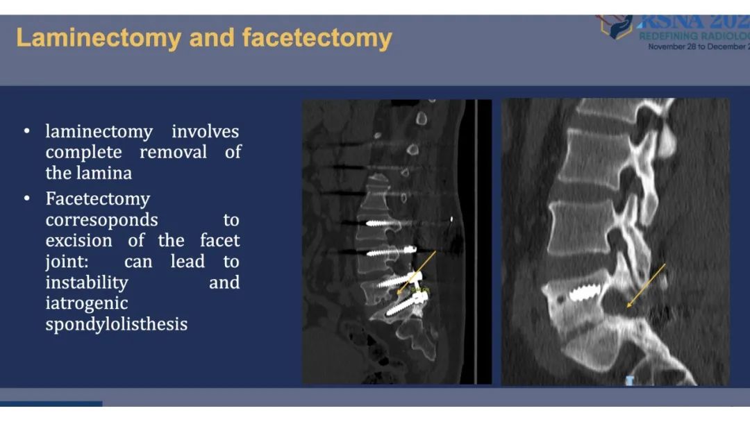 【PPT】术后脊柱-为了外科医生和患者安全着想的金属图像-12