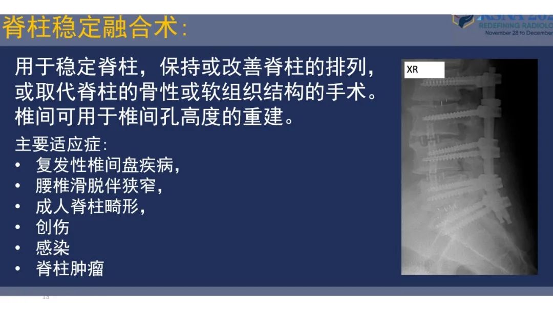【PPT】术后脊柱-为了外科医生和患者安全着想的金属图像-13