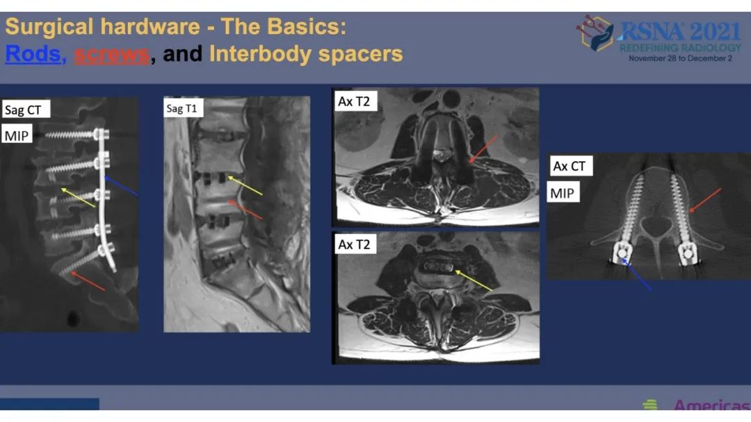 【PPT】术后脊柱-为了外科医生和患者安全着想的金属图像-18