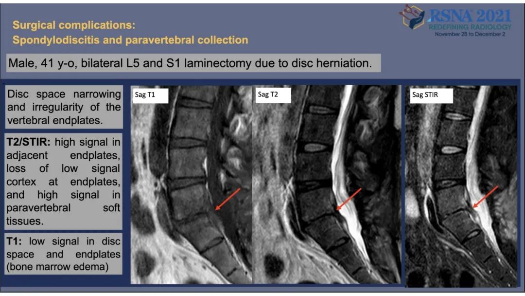【PPT】术后脊柱-为了外科医生和患者安全着想的金属图像-38