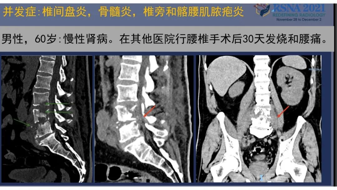 【PPT】术后脊柱-为了外科医生和患者安全着想的金属图像-43