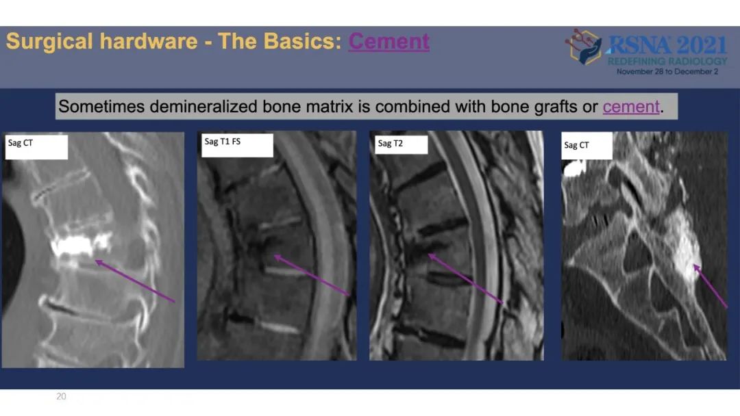【PPT】术后脊柱-为了外科医生和患者安全着想的金属图像-20