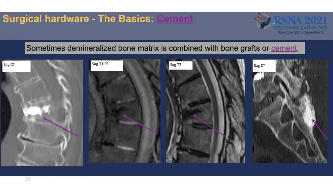 【PPT】术后脊柱-为了外科医生和患者安全着想的金属图像-20