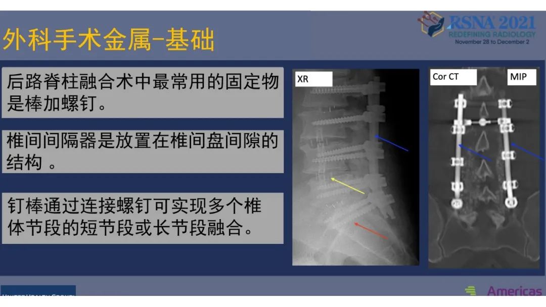 【PPT】术后脊柱-为了外科医生和患者安全着想的金属图像-15