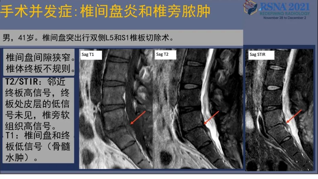 【PPT】术后脊柱-为了外科医生和患者安全着想的金属图像-37