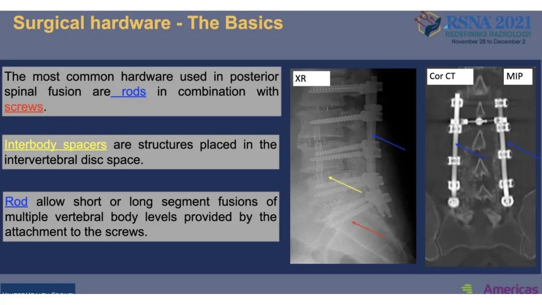 【PPT】术后脊柱-为了外科医生和患者安全着想的金属图像-16