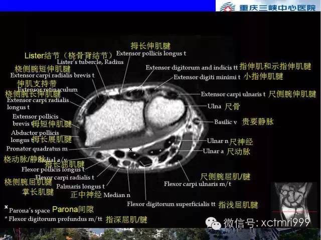 【PPT】腕关节MRI解剖中英对照-33