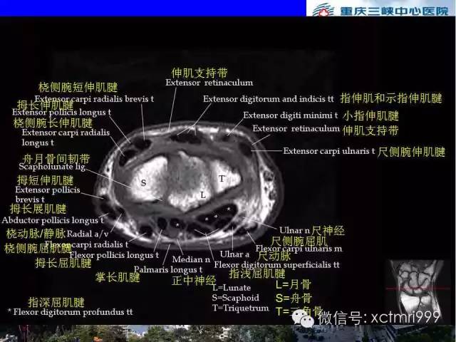 【PPT】腕关节MRI解剖中英对照-39