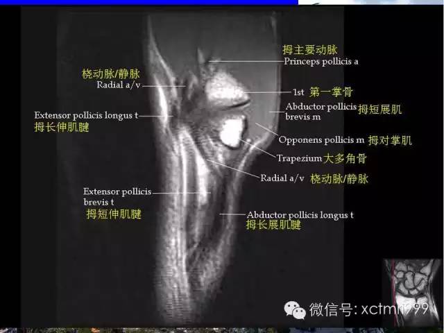 【PPT】腕关节MRI解剖中英对照-29