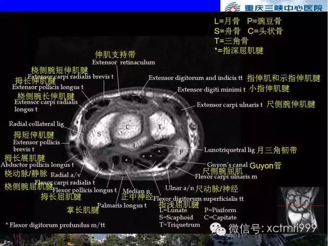 【PPT】腕关节MRI解剖中英对照-40