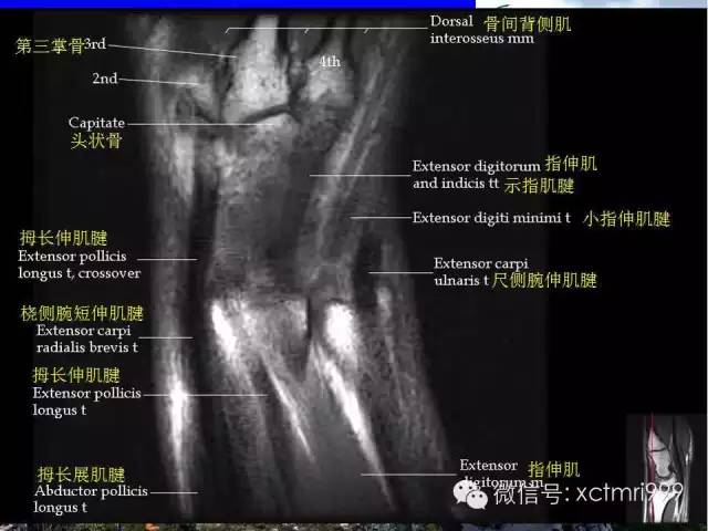 【PPT】腕关节MRI解剖中英对照-12