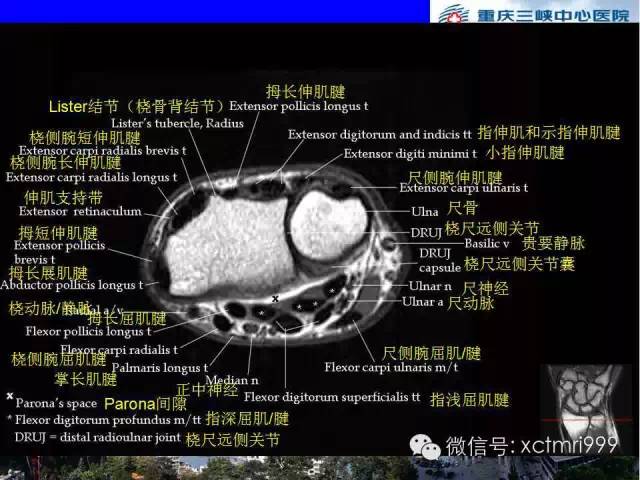 【PPT】腕关节MRI解剖中英对照-34