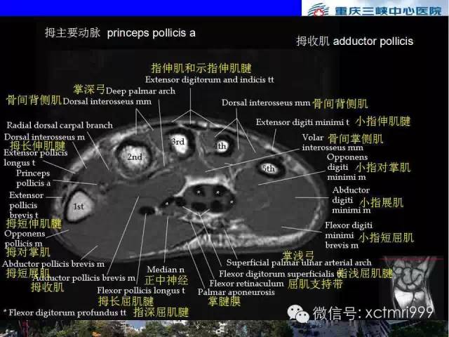 【PPT】腕关节MRI解剖中英对照-50