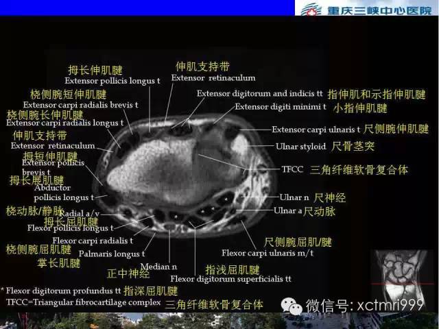 【PPT】腕关节MRI解剖中英对照-36