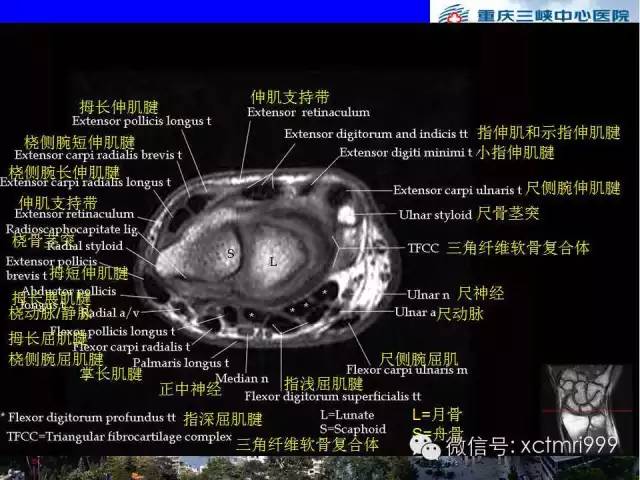 【PPT】腕关节MRI解剖中英对照-37