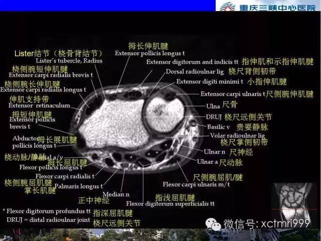 【PPT】腕关节MRI解剖中英对照-35