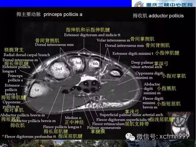 【PPT】腕关节MRI解剖中英对照-49