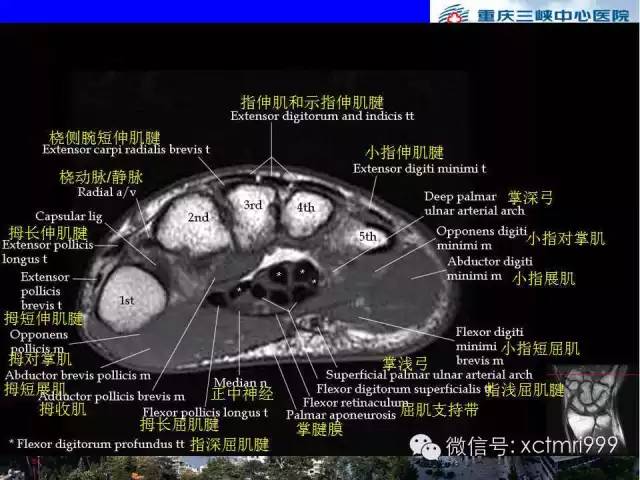 【PPT】腕关节MRI解剖中英对照-48