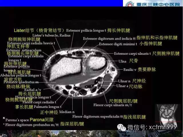 【PPT】腕关节MRI解剖中英对照-32