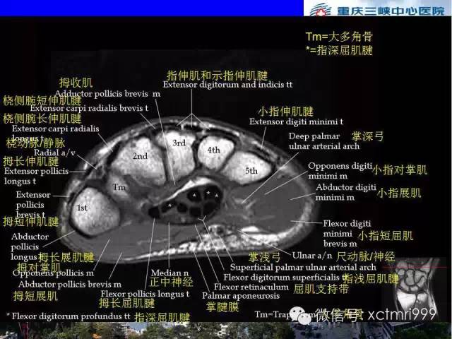 【PPT】腕关节MRI解剖中英对照-47