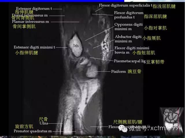 【PPT】腕关节MRI解剖中英对照-16