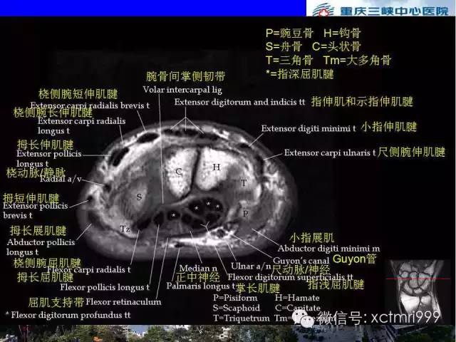 【PPT】腕关节MRI解剖中英对照-43