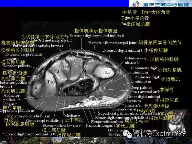 【PPT】腕关节MRI解剖中英对照-46