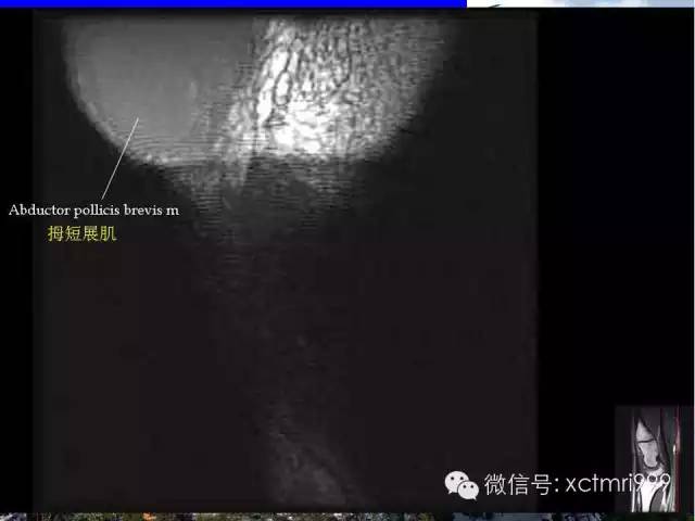 【PPT】腕关节MRI解剖中英对照-3