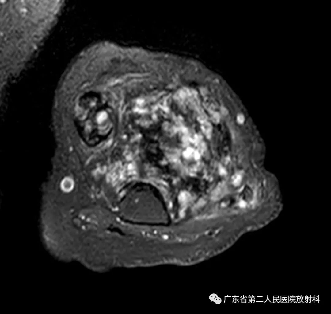 【病例】截肢后残端还能长肿物—创伤性神经瘤1例MR影像-11