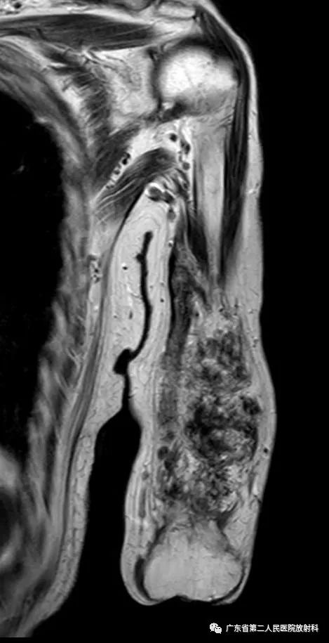 【病例】截肢后残端还能长肿物—创伤性神经瘤1例MR影像-7