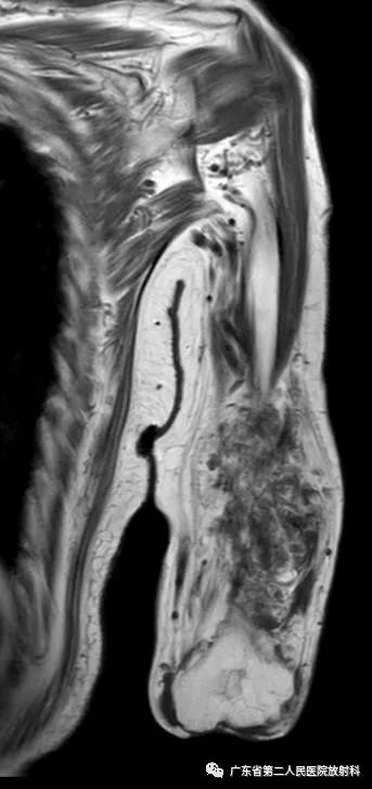【病例】截肢后残端还能长肿物—创伤性神经瘤1例MR影像-6