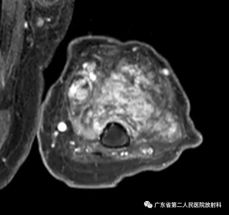 【病例】截肢后残端还能长肿物—创伤性神经瘤1例MR影像-14