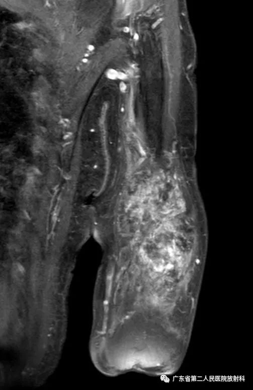 【病例】截肢后残端还能长肿物—创伤性神经瘤1例MR影像-13