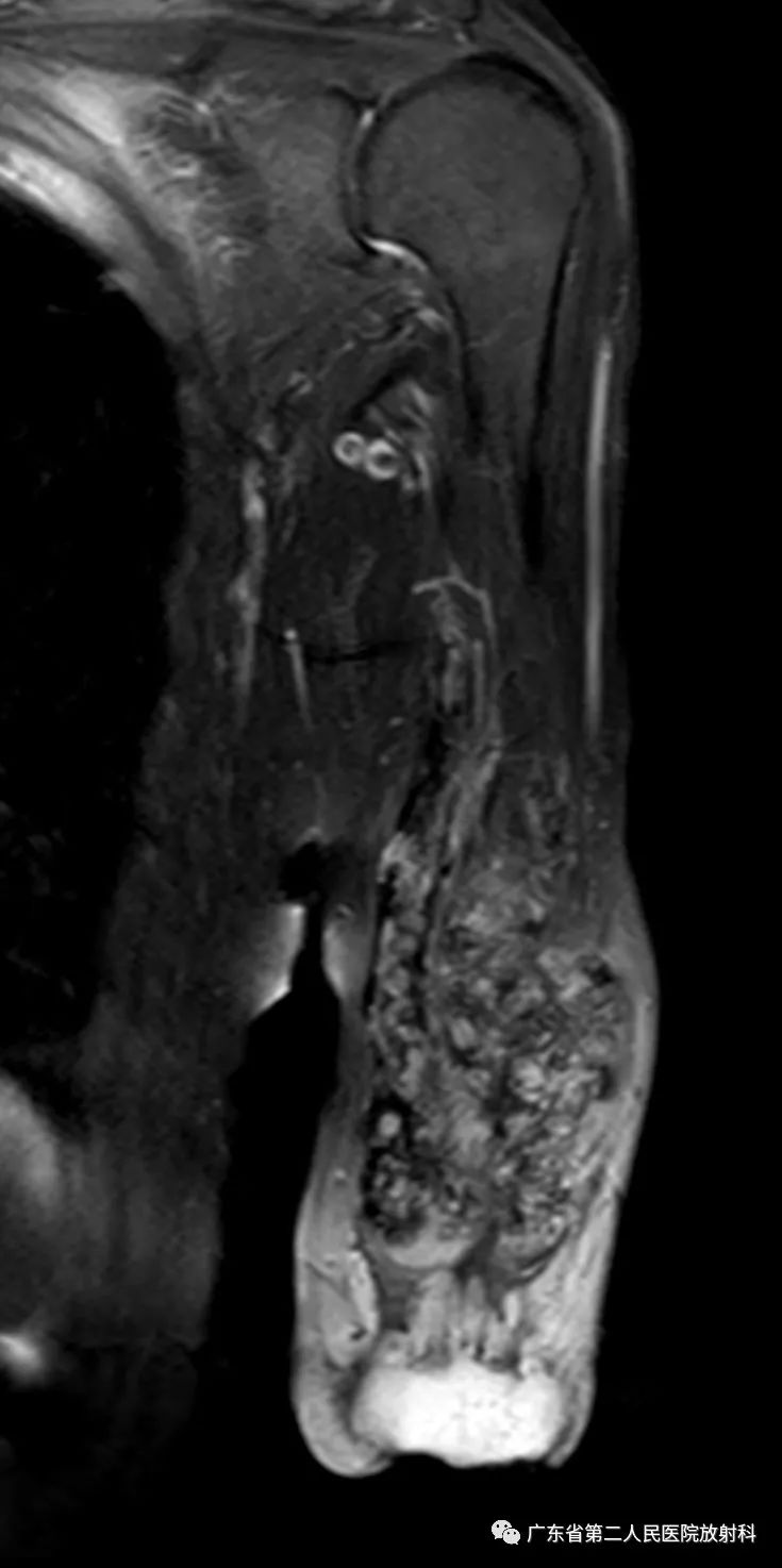 【病例】截肢后残端还能长肿物—创伤性神经瘤1例MR影像-10