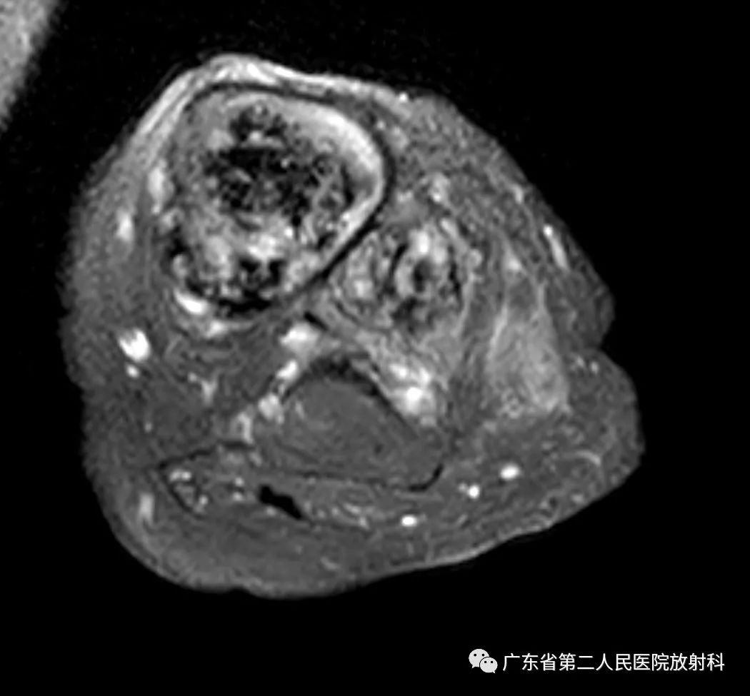 【病例】截肢后残端还能长肿物—创伤性神经瘤1例MR影像-12