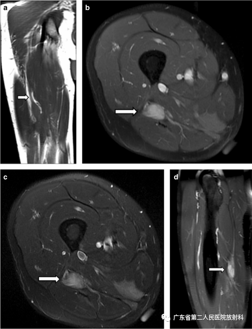 【病例】截肢后残端还能长肿物—创伤性神经瘤1例MR影像-15