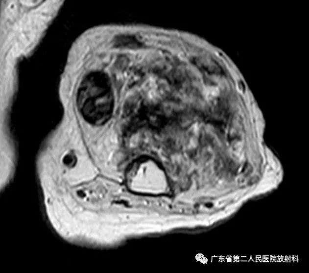 【病例】截肢后残端还能长肿物—创伤性神经瘤1例MR影像-8