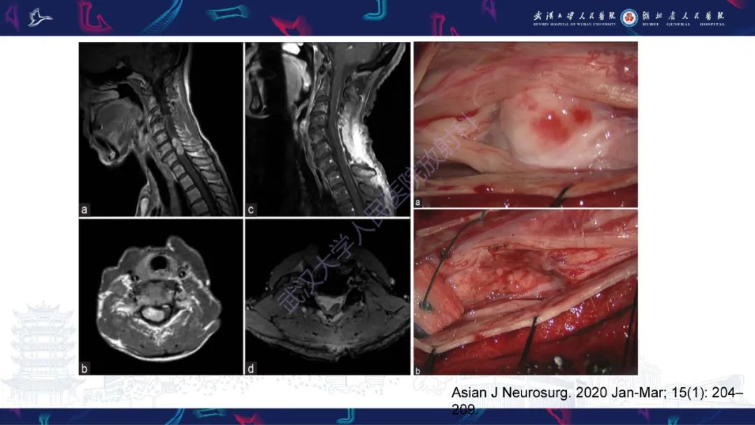 【PPT】椎管内孤立性纤维瘤/血管外皮细胞瘤影像诊断-16