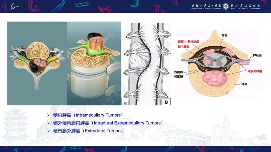 【PPT】椎管内孤立性纤维瘤/血管外皮细胞瘤影像诊断-8