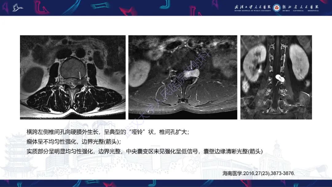 【PPT】椎管内孤立性纤维瘤/血管外皮细胞瘤影像诊断-23