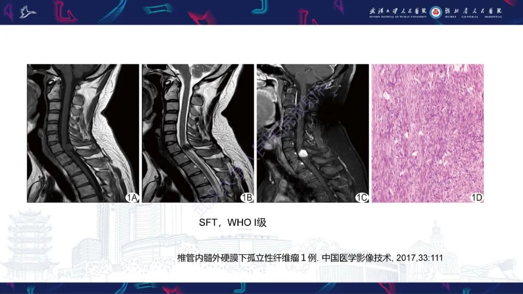 【PPT】椎管内孤立性纤维瘤/血管外皮细胞瘤影像诊断-19