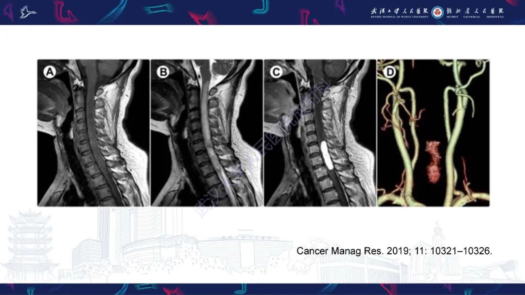 【PPT】椎管内孤立性纤维瘤/血管外皮细胞瘤影像诊断-17