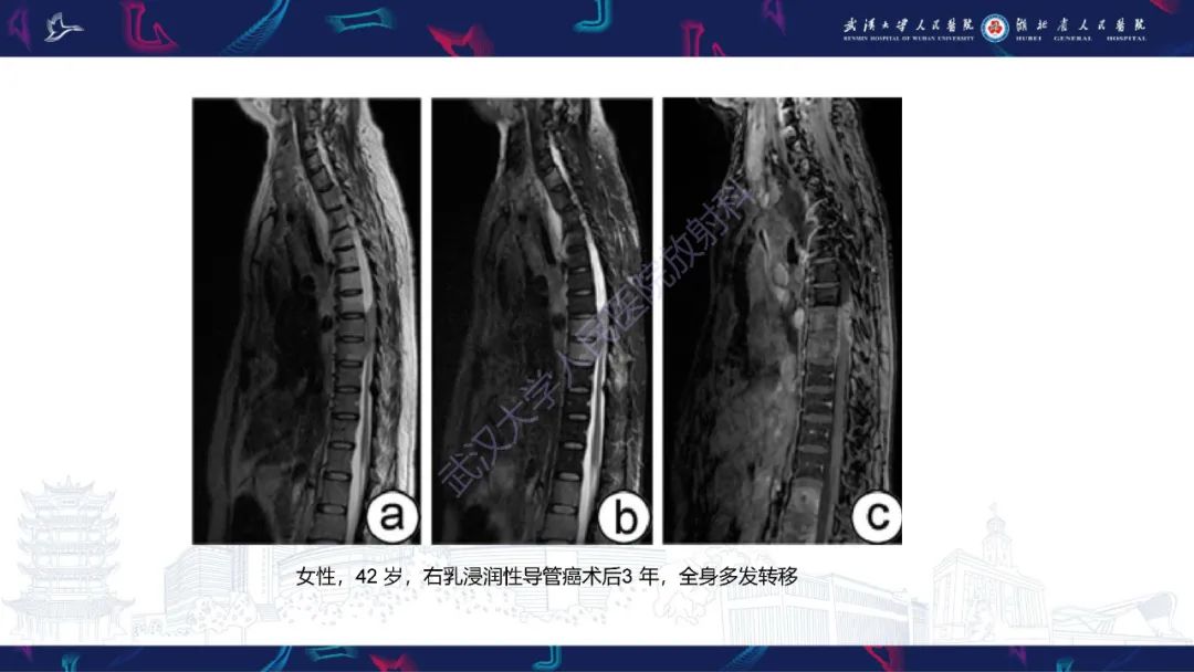 【PPT】椎管内孤立性纤维瘤/血管外皮细胞瘤影像诊断-27