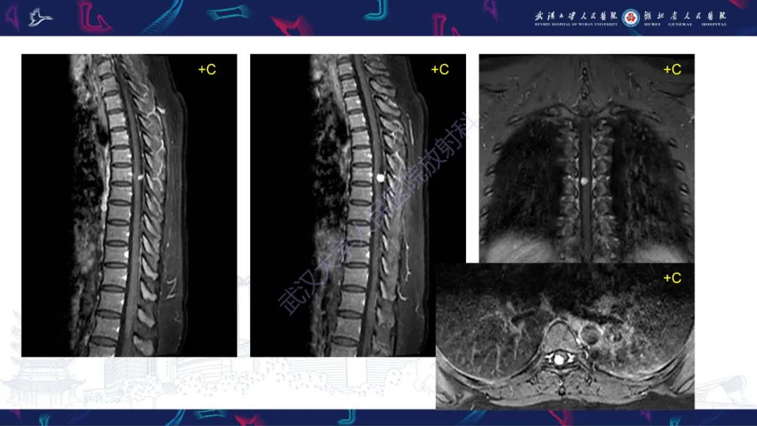 【PPT】椎管内孤立性纤维瘤/血管外皮细胞瘤影像诊断-4