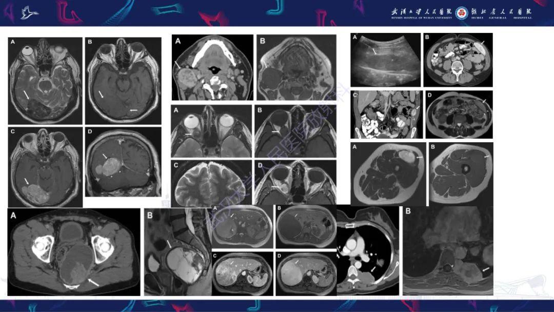 【PPT】椎管内孤立性纤维瘤/血管外皮细胞瘤影像诊断-10