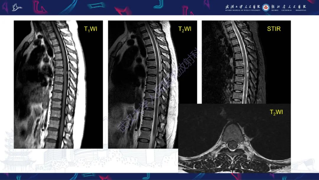 【PPT】椎管内孤立性纤维瘤/血管外皮细胞瘤影像诊断-3