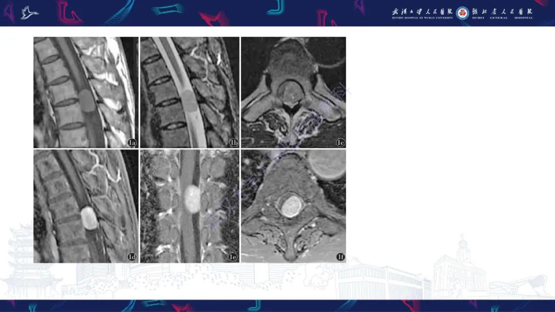 【PPT】椎管内孤立性纤维瘤/血管外皮细胞瘤影像诊断-20